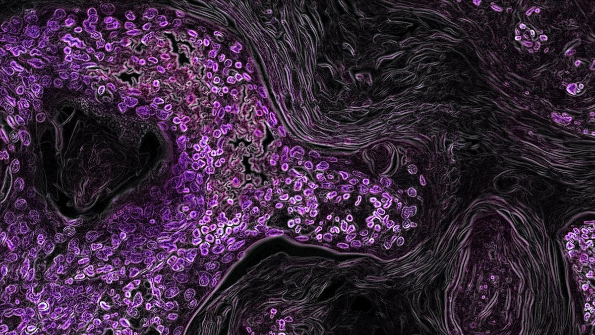 Tejido pulmonar con cáncer provocado por una mutación del gen KRAS, señalado en color morado.