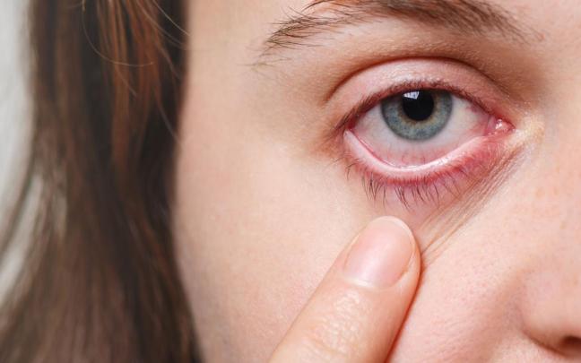 La sangre acumulada en la conjuntiva suele reabsorberse por sí misma, si no, conviene consultar al médico. / Freepik La sangre acumulada en la conjuntiva suele reabsorberse por sí misma, si no, conviene consultar al médico.