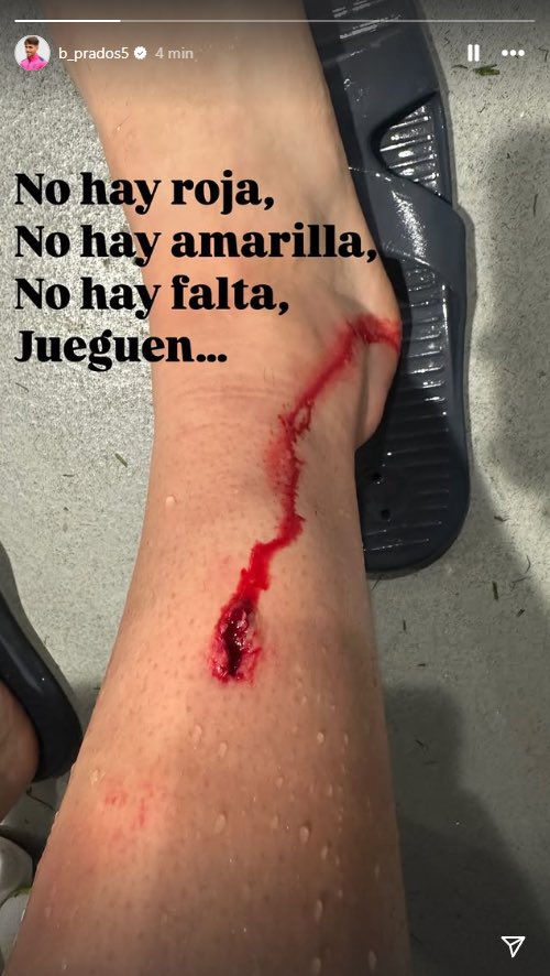 Beñat Prados compartió una imagen de su pierna en redes sociales / b_prados5 Beñat Prados compartió una imagen de su pierna en redes sociales / b_prados5