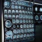 Es necesario distinguir entre las dos clases de ictus que existen: el isquémico y el hemorrágico. Pixabay