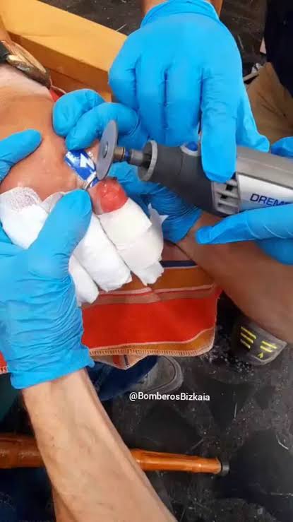 Retirada de anillo de dedo engrosado, 