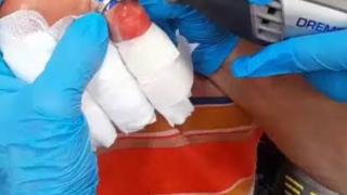 Retirada de anillo de dedo engrosado, 