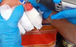 Retirada de anillo de dedo engrosado, 
