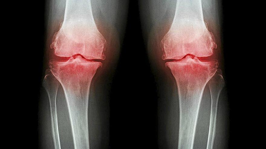 a pérdida de densidad de los huesos puede provocar fracturas