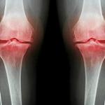 a pérdida de densidad de los huesos puede provocar fracturas