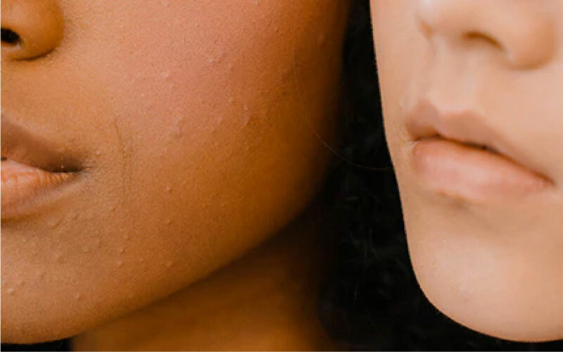 Piel de la cara de dos personas