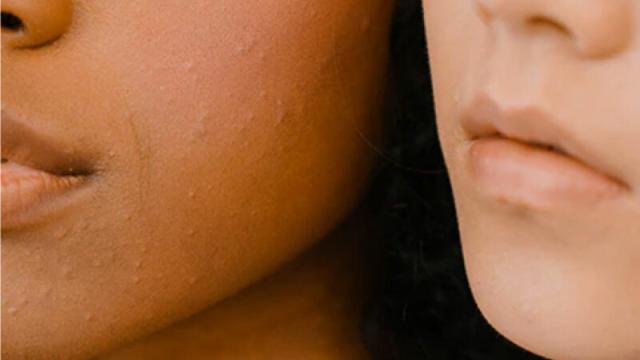 Piel de la cara de dos personas